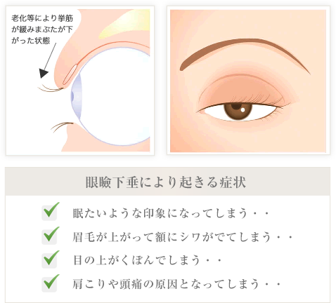 眼瞼下垂により起きる症状